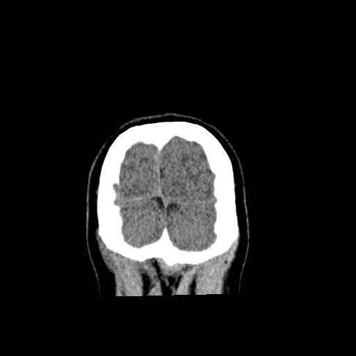 Cerebral cavernous venous malformation (Radiopaedia 70008-80022 non-contrast 66).jpg