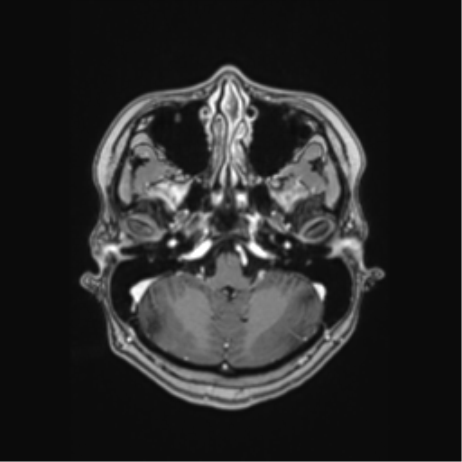 Cerebral cavernous venous malformations (Radiopaedia 48117-52946 Axial T1 C+ 7).png