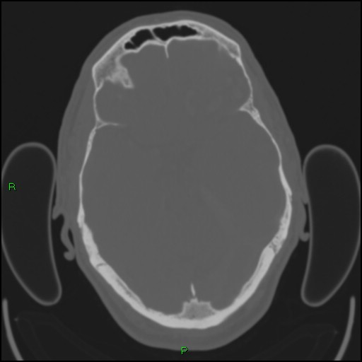Cerebral contusions (Radiopaedia 33868-35039 Axial bone window 74).jpg