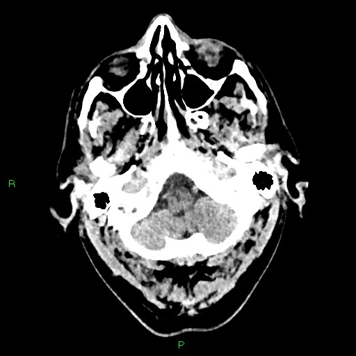 File:Cerebral contusions (Radiopaedia 33868-35039 Axial non-contrast 21).jpg
