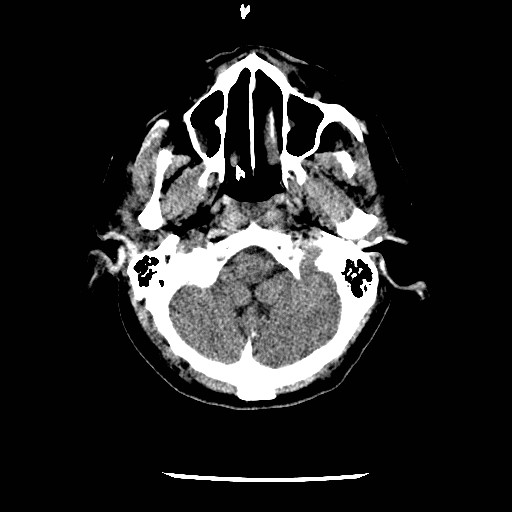 File:Cerebral edema (evolution in time) (Radiopaedia 19418-19441 non-contrast 13).jpg
