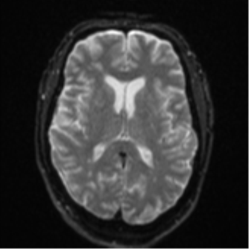Cerebral embolic infarcts (embolic shower) (Radiopaedia 57395-64342 Axial DWI 20).png