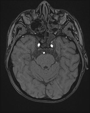 Cerebral embolic infarcts (embolic shower) (Radiopaedia 72391-82921 Axial MRA 42).jpg