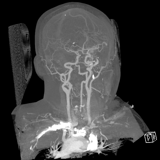 File:Cerebral hemorrhage secondary to arteriovenous malformation (Radiopaedia 33497-34571 A 35).png