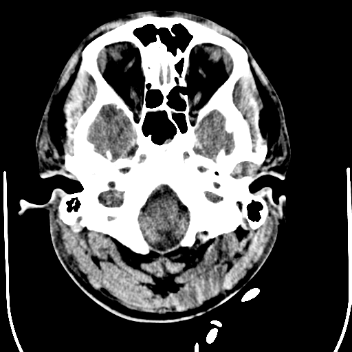 File:Cerebral hemorrhagic contusions- temporal evolution (Radiopaedia 40224-42755 AXIAL THICK 4).png