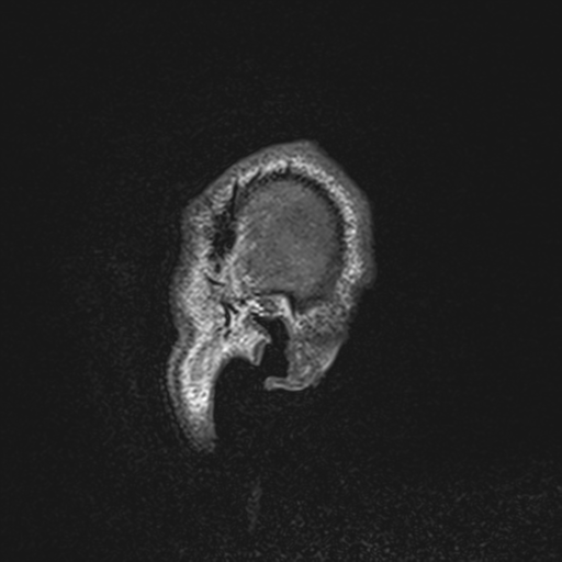 File:Cerebral hemorrhagic contusions- temporal evolution (Radiopaedia 40224-42757 Sagittal T1 4).png