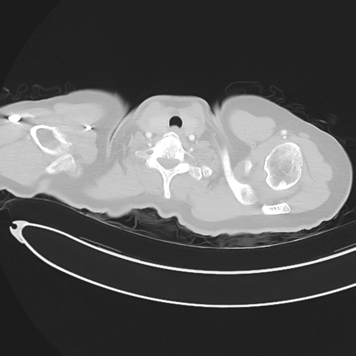 Cerebral metastases (Radiopaedia 33041-34055 Axial lung window 3).png