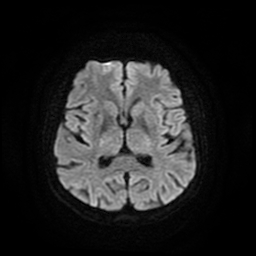 Cerebral metastases - melanoma (Radiopaedia 80972-94522 Axial DWI 49).jpg