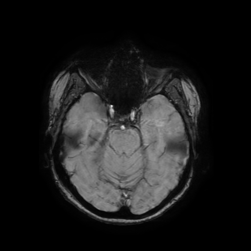 Cerebral metastases - melanoma (Radiopaedia 80972-94522 Axial SWI 34).jpg