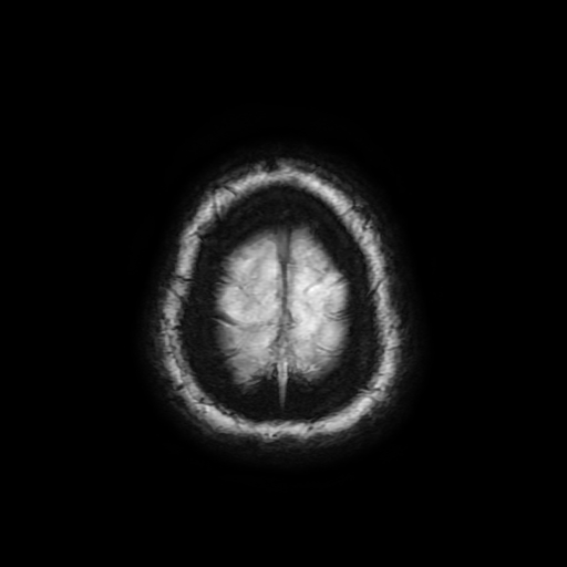 Cerebral metastases - melanoma (Radiopaedia 80972-94522 Axial SWI 94).jpg