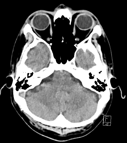 Cerebral metastases - testicular choriocarcinoma (Radiopaedia 84486-99855 Axial non-contrast 42).jpg