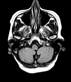 File:Cerebral metastasis (Radiopaedia 46744-51248 Axial FLAIR 4).png