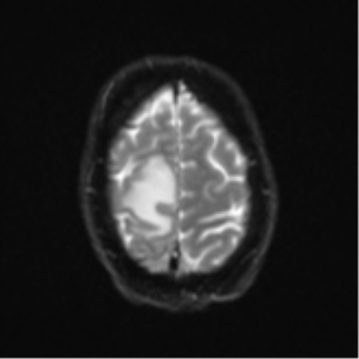 Cerebral metastasis - colorectal adenocarcinoma (Radiopaedia 50394-55765 Axial DWI 24).png