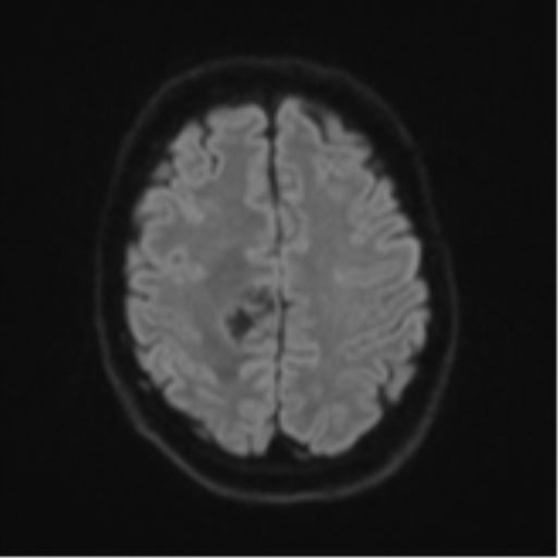Cerebral metastasis - colorectal adenocarcinoma (Radiopaedia 50394-55765 Axial DWI 49).png