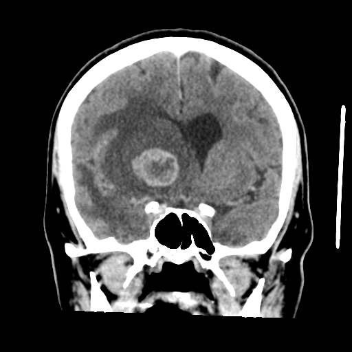 Cerebral metastasis to basal ganglia (Radiopaedia 81568-95412 Coronal C+ delayed 26).png