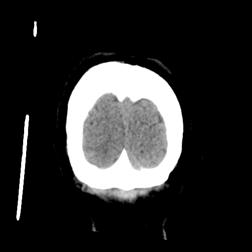 Cerebral metastasis to basal ganglia (Radiopaedia 81568-95412 Coronal non-contrast 60).png