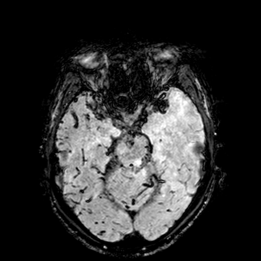 Cerebral parenchymal arteriovenous malformation (Radiopaedia 27280-27456 Axial SWI 36).jpg