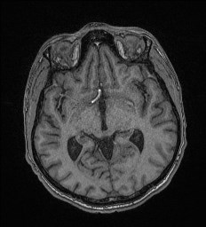 File:Cerebral toxoplasmosis (Radiopaedia 43956-47461 Axial T1 34).jpg