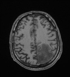 File:Cerebral toxoplasmosis (Radiopaedia 43956-47461 Axial T1 58).jpg