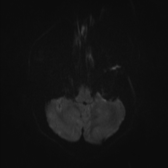 Cerebral toxoplasmosis (Radiopaedia 53993-60132 Axial DWI 32).jpg