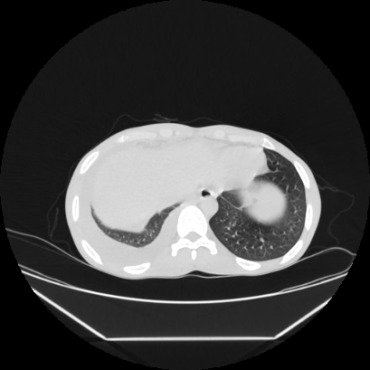 Cerebral tuberculoma (Radiopaedia 80829-94318 Axial lung window 157).jpg