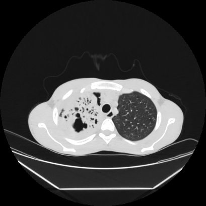 Cerebral tuberculoma (Radiopaedia 80829-94318 Axial lung window 34).jpg