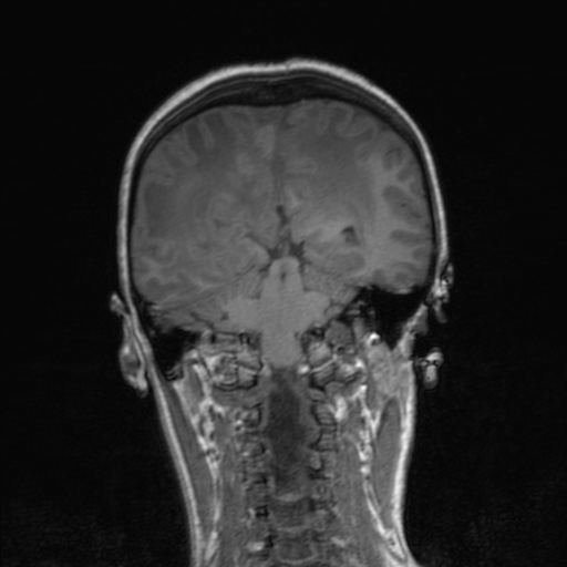 Cerebral tuberculosis with dural sinus invasion (Radiopaedia 60353-68090 Coronal T1 123).jpg