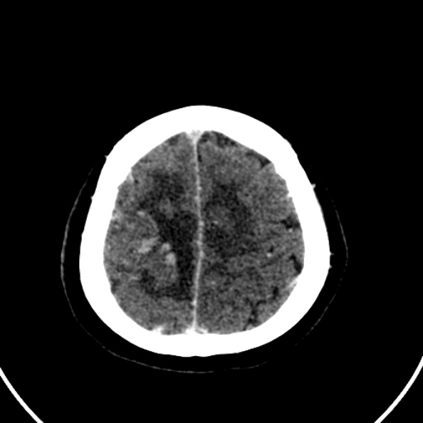 Cerebral venous hemorrhagic infarct from venous sinus thrombosis (Radiopaedia 55433-61883 Axial C+ delayed 27).jpg