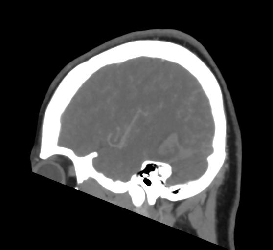 Cerebral venous infarction due to transverse sinus thrombosis (Radiopaedia 34688-36120 Sagittal CT venogram 15).png