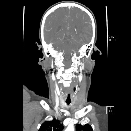 Cerebral venous infarction with hemorrhage (Radiopaedia 65343-74396 B 185).jpg