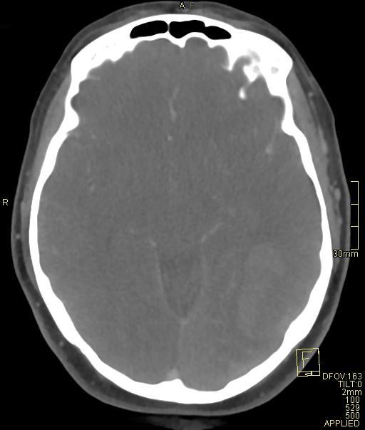Cerebral venous sinus thrombosis (Radiopaedia 91329-108965 Axial venogram 37).jpg