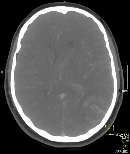 Cerebral venous sinus thrombosis (Radiopaedia 91329-108965 Axial venogram 46).jpg