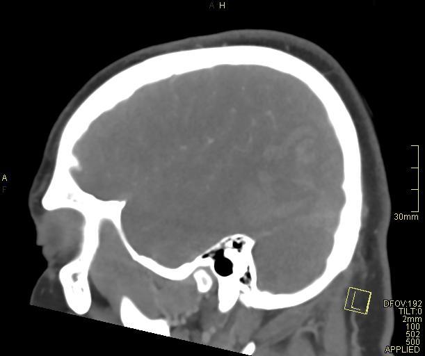Cerebral venous sinus thrombosis (Radiopaedia 91329-108965 Sagittal venogram 60).jpg