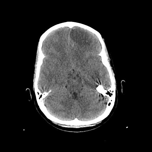 Cerebral venous throbmosis - hemorrhagic venous infarction (Radiopaedia 87318-103613 Axial non-contrast 55).jpg