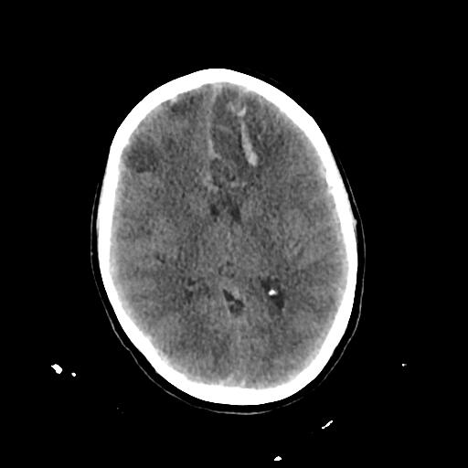 Cerebral venous throbmosis - hemorrhagic venous infarction (Radiopaedia 87318-103613 Axial non-contrast 90).jpg