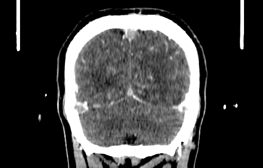 Cerebral venous thrombosis (CVT) (Radiopaedia 77524-89685 C 53).jpg