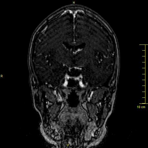 Cerebral venous thrombosis (Radiopaedia 23288-23351 MRV 67).JPG