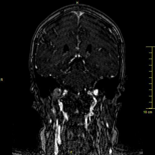 File:Cerebral venous thrombosis (Radiopaedia 23288-23351 MRV 98).JPG