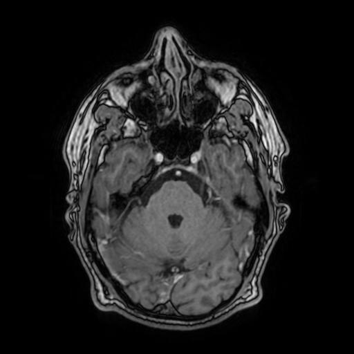 File:Cerebral venous thrombosis with secondary intracranial hypertension (Radiopaedia 89842-106957 Axial T1 C+ 63).jpg