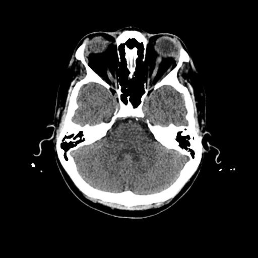 File:Cerebral venous thrombosis with venous hemorrhagic infarct (Radiopaedia 90354-107660 Axial non-contrast 15).jpg