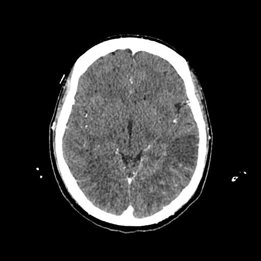 File:Cerebral venous thrombosis with venous hemorrhagic infarct (Radiopaedia 90354-107660 Axial with contrast 78).jpg