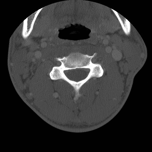 Cervical Pott disease (Radiopaedia 20374-20286 Axial bone window 65).jpg