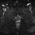 Cervical adenocarcinoma (Radiopaedia 65011-73985 Axial DWI 16).jpg