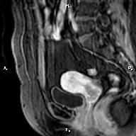 File:Cervical adenocarcinoma (Radiopaedia 65011-73985 E 14).jpg