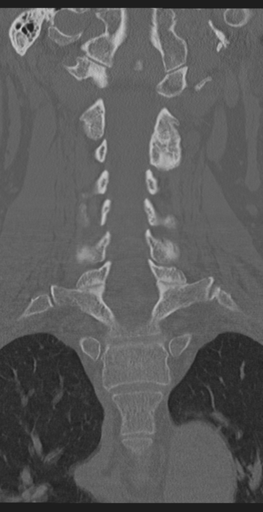Cervical canal stenosis due to ossification of the posterior longitudinal ligament (Radiopaedia 47260-51823 Coronal bone window 30).png