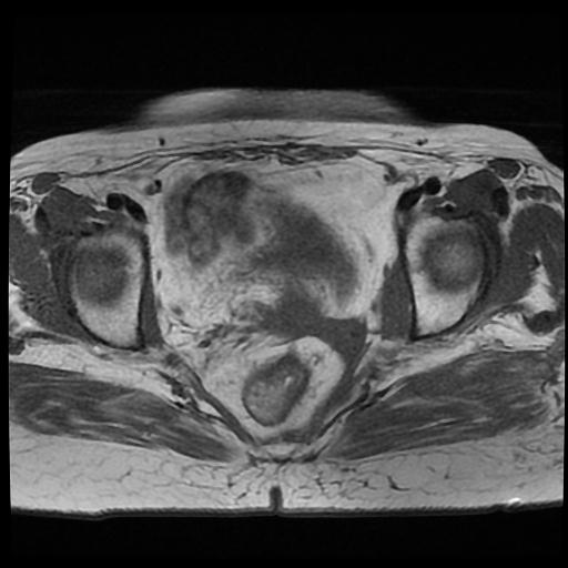 File:Cervical carcinoma (Radiopaedia 70924-81132 Axial T1 9).jpg
