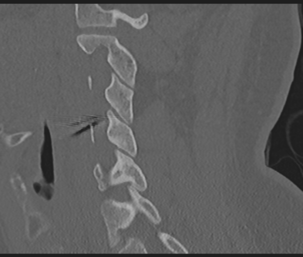 Cervical disc replacement (Radiopaedia 44025-47541 Sagittal bone window 32).png