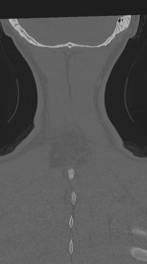Cervical intercalary bone (Radiopaedia 35211-36748 Coronal bone window 74).png
