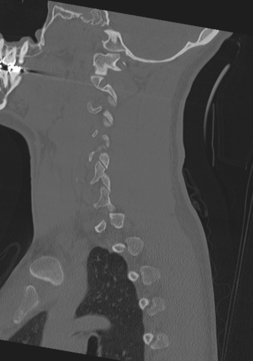 Cervical intercalary bone (Radiopaedia 35211-36748 Sagittal bone window 57).png