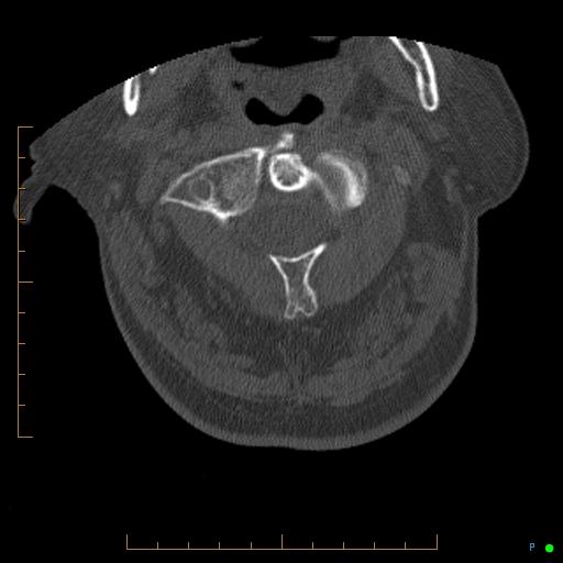 Cervical spine fracture - ankylosing spondylitis (Radiopaedia 76835-88706 Axial bone window 40).jpg